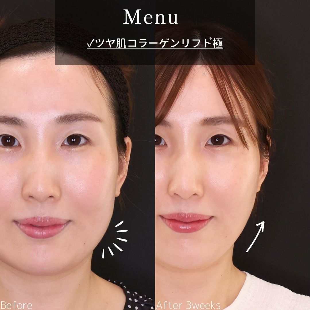 TAC式 ツヤ肌コラーゲンリフト®の症例写真 施術前後 