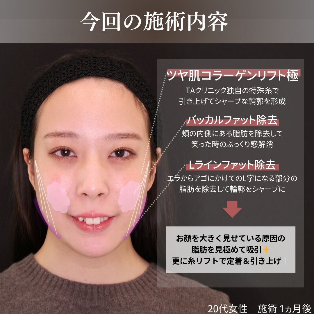 TAC式 ツヤ肌コラーゲンリフト®/バッカルファット除去/Lラインファット除去(エラ下脂肪除去)の症例写真 施術前後