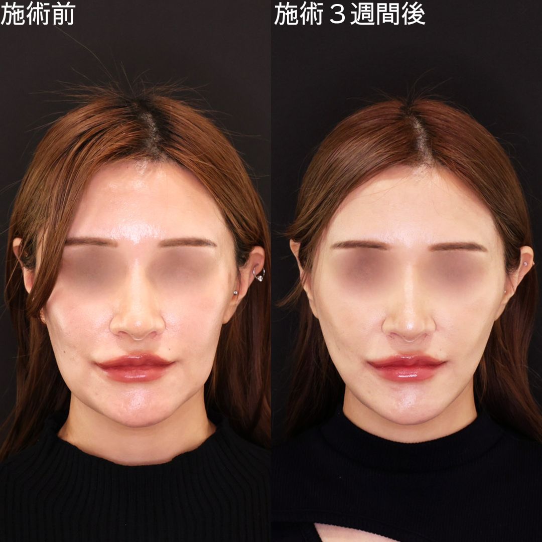 糸で輪郭のボコつきを整える！Dr.石橋の小顔洗練術【糸リフト】