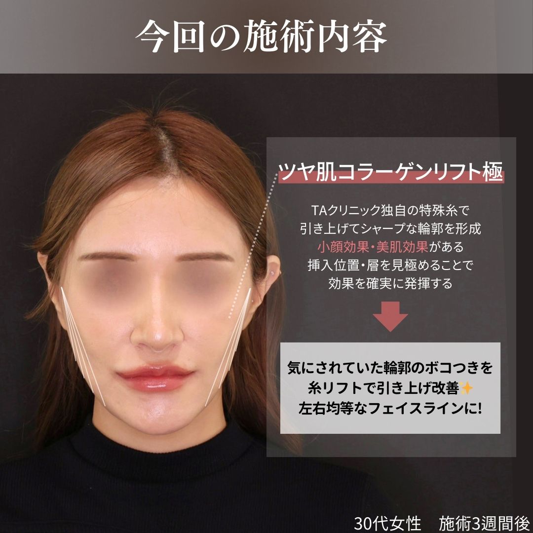 TAC式 ツヤ肌コラーゲンリフト®の症例写真 施術前後 
