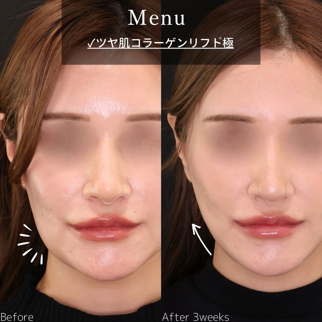 TAC式 ツヤ肌コラーゲンリフト®の症例写真 施術前後 