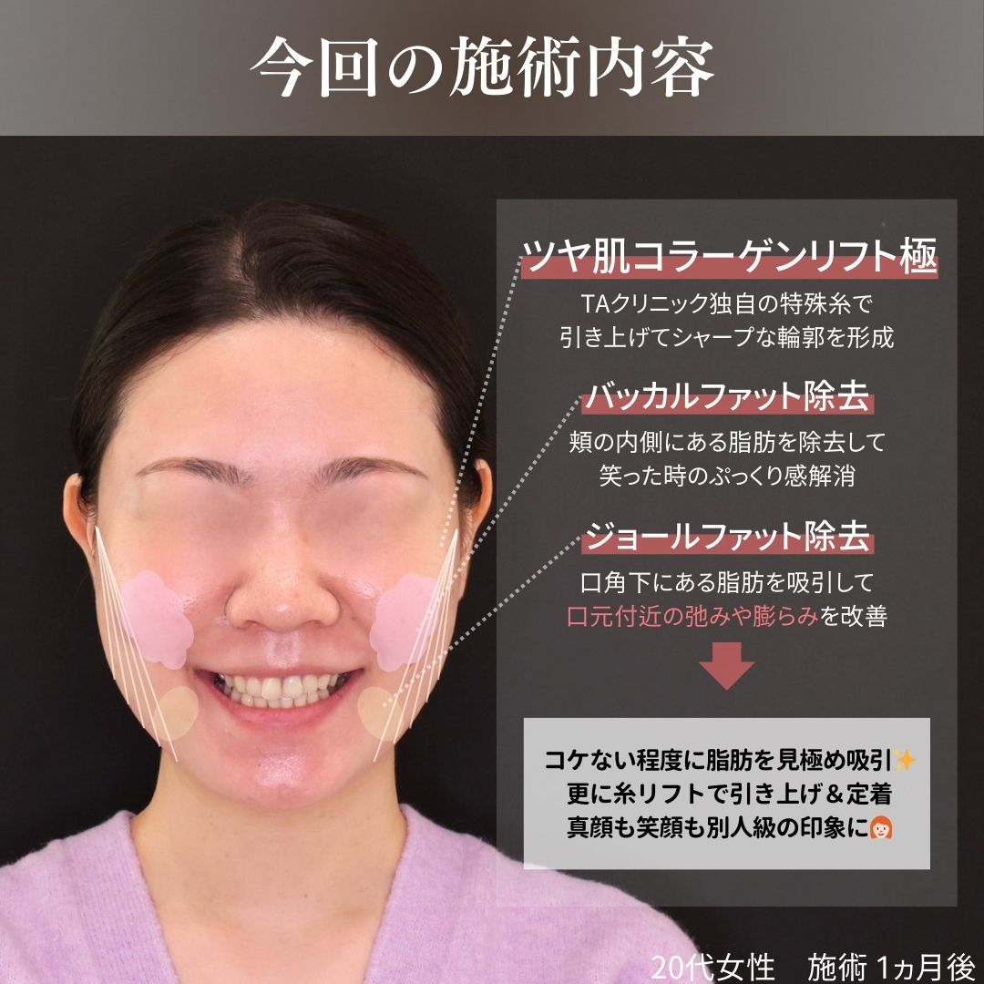 TAC式 ツヤ肌コラーゲンリフト®/バッカルファット除去/ジョールファット除去の症例写真 施術前後