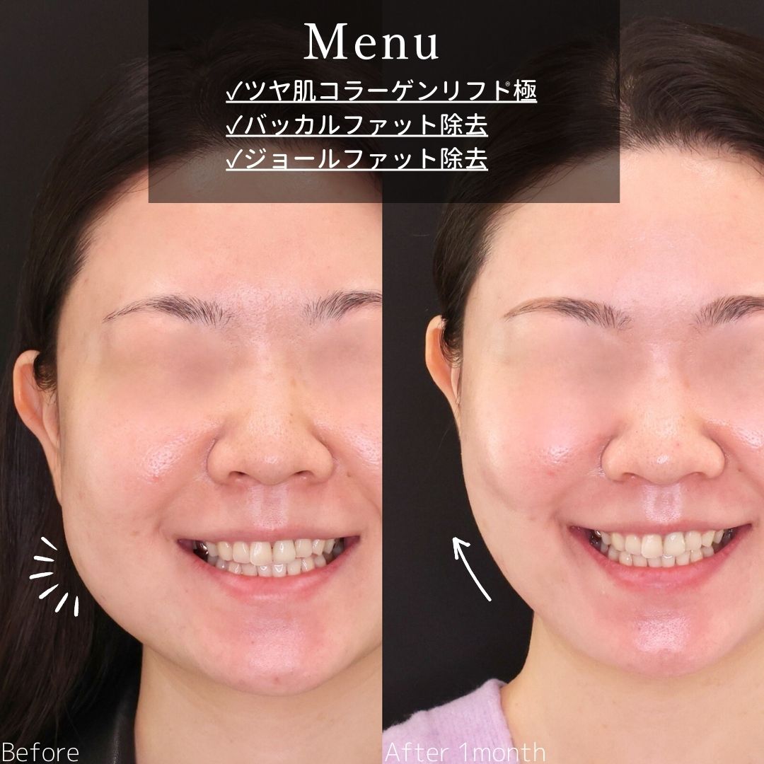 TAC式 ツヤ肌コラーゲンリフト®/バッカルファット除去/ジョールファット除去の症例写真 施術前後