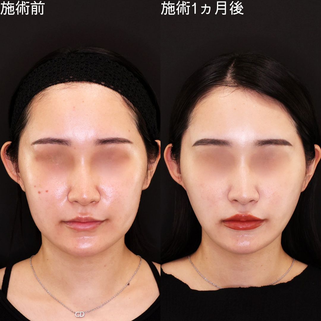 糸リフト×脂肪除去で加工級小顔術