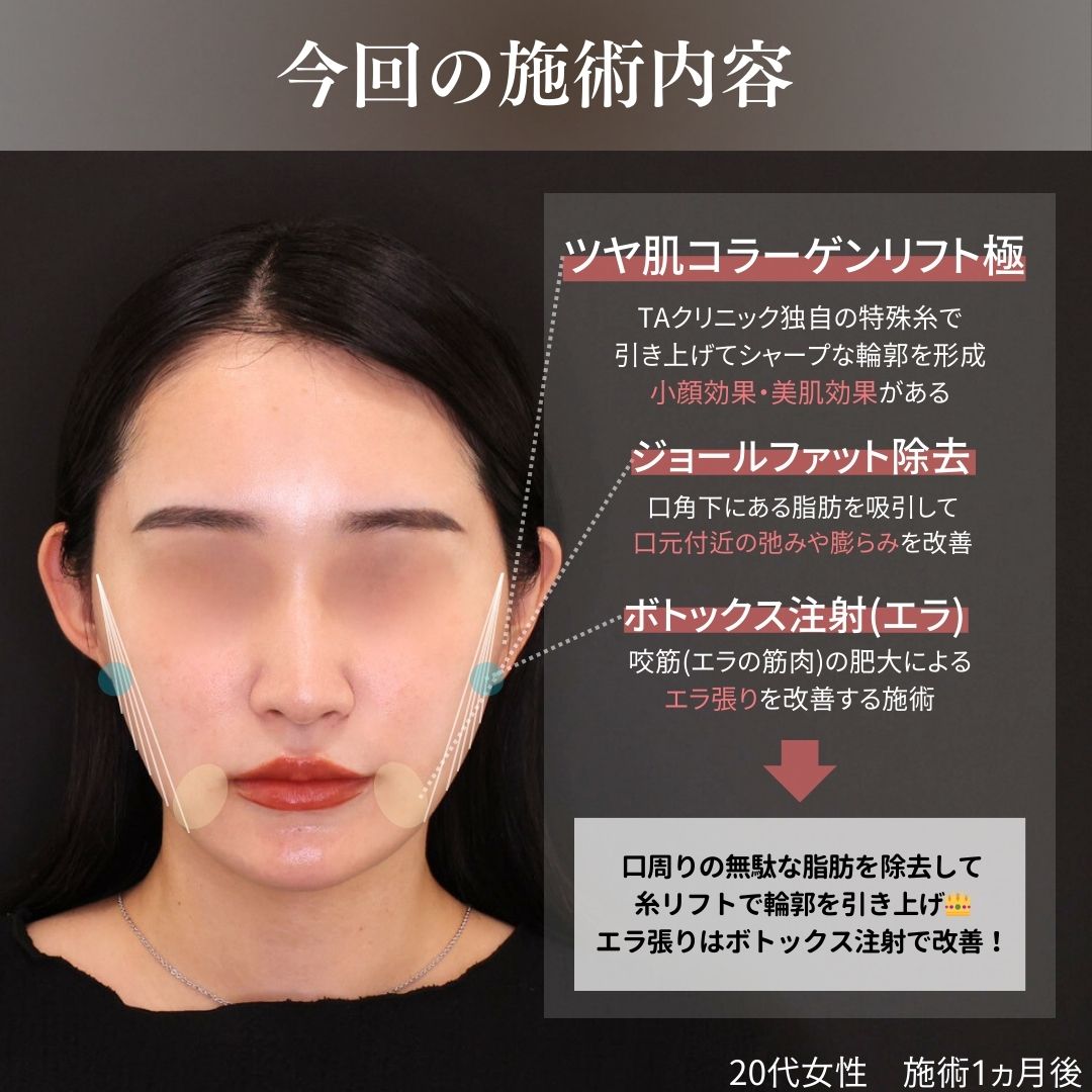 TAC式 ツヤ肌コラーゲンリフト®/ジョールファット除去/エラボトックス注射の症例写真 施術前後 