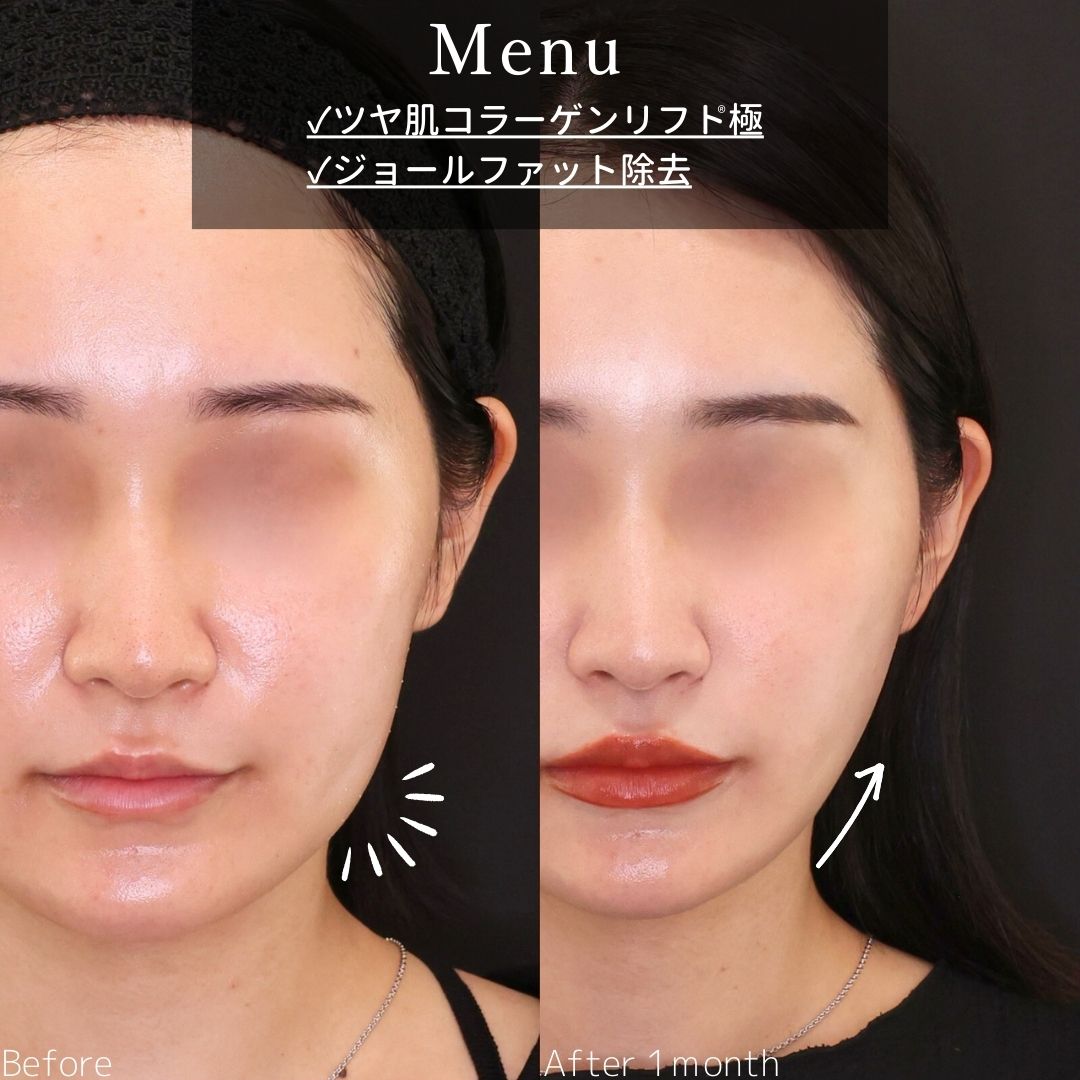 TAC式 ツヤ肌コラーゲンリフト®/ジョールファット除去/エラボトックス注射の症例写真 施術前後 