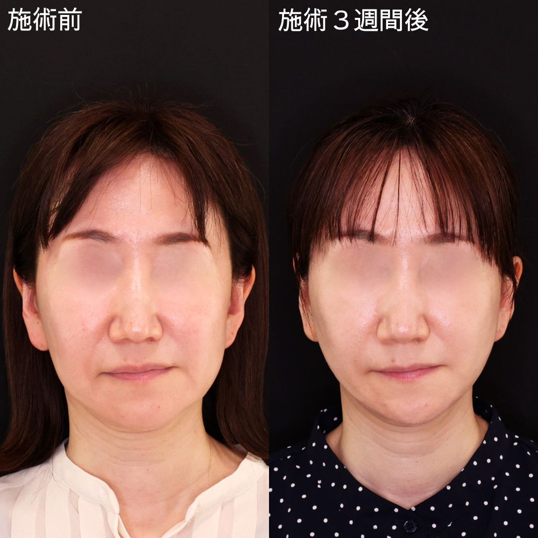 糸リフトのみで弛みを改善！輪郭洗練術【糸リフト】