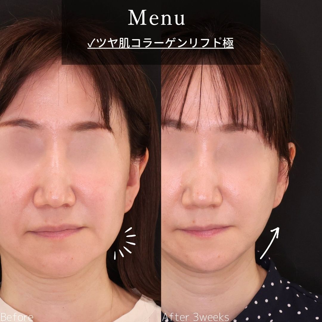 TAC式 ツヤ肌コラーゲンリフト®の症例写真 施術前後 