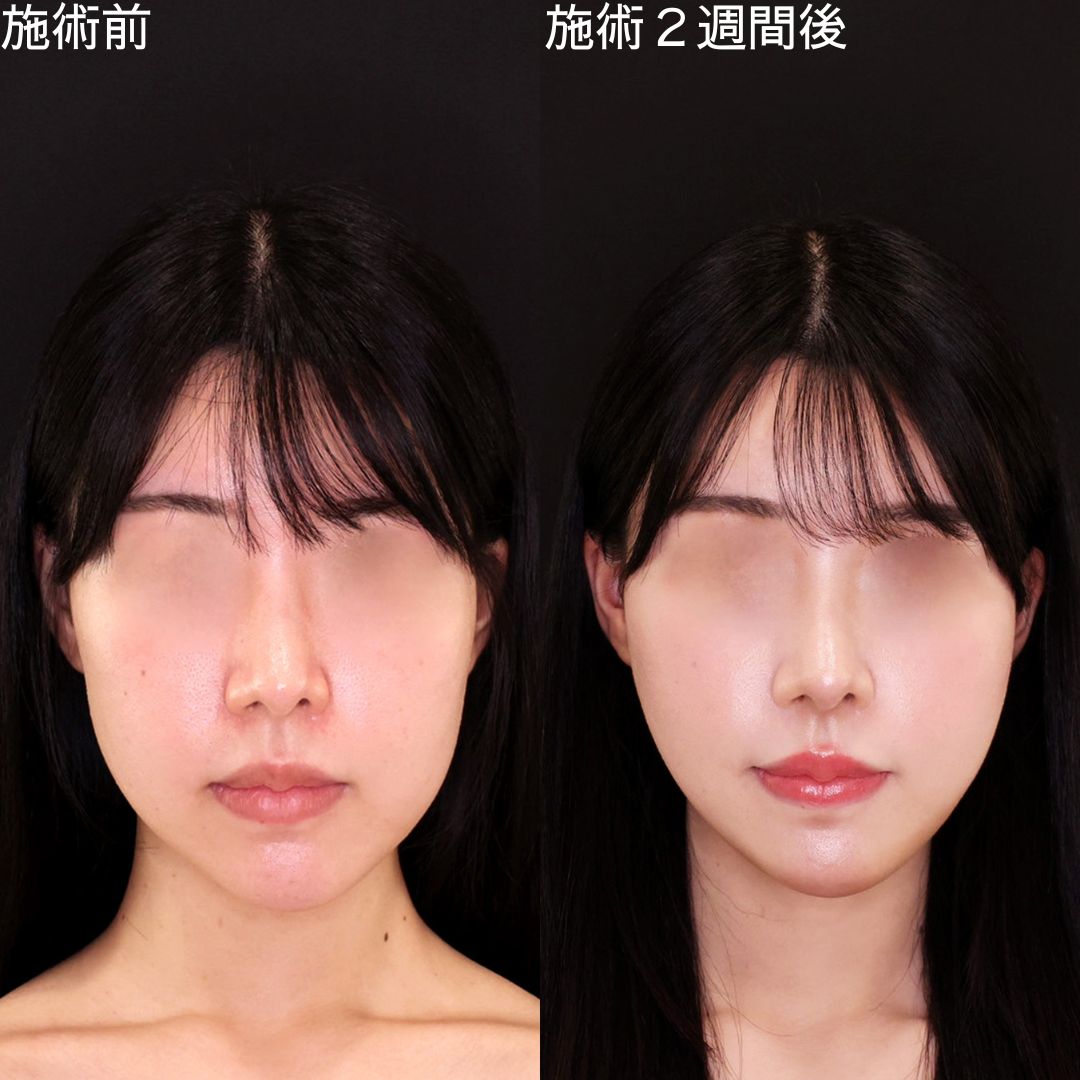 【糸リフト】糸の本数を調節して左右差を整える