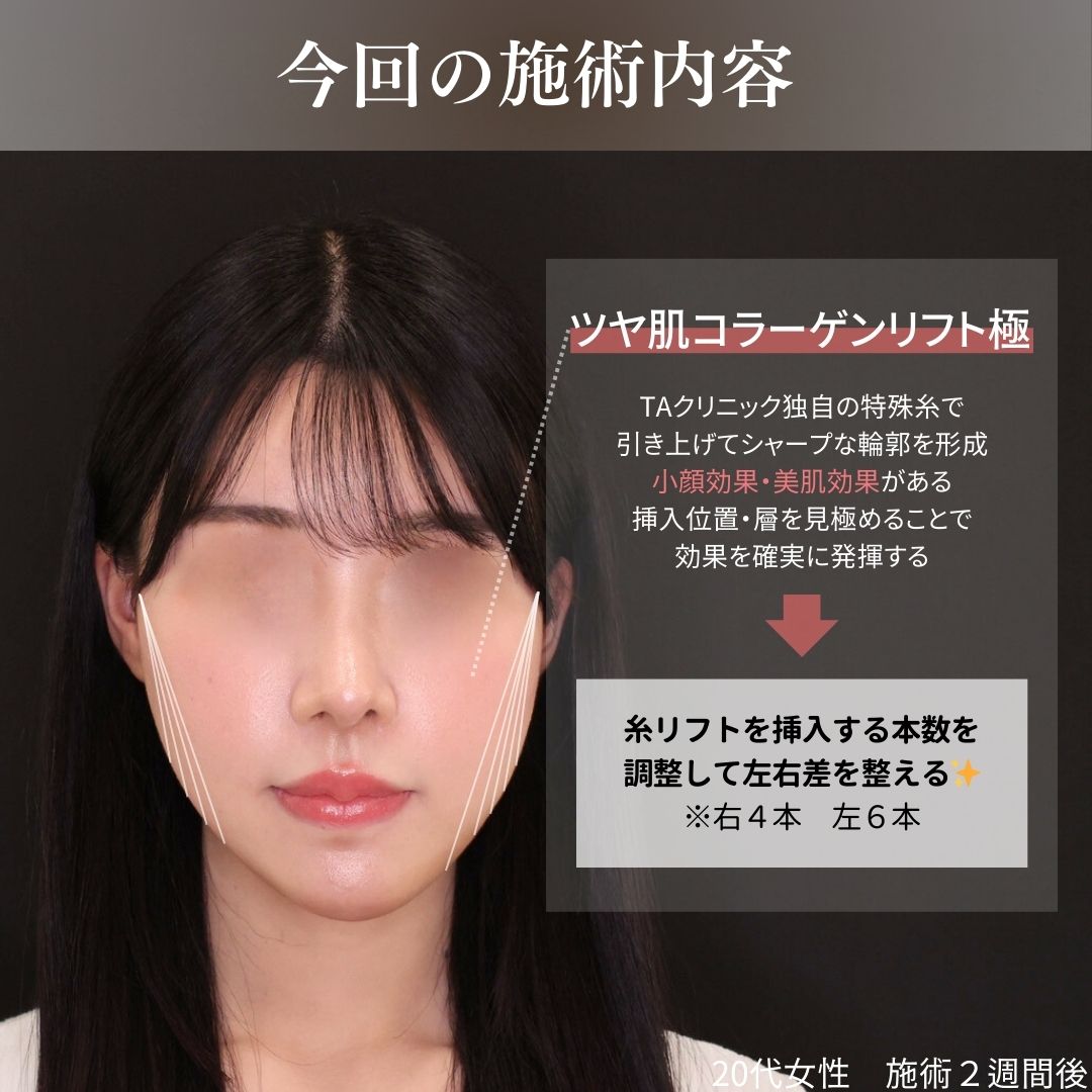 TAC式 ツヤ肌コラーゲンリフト®の症例写真 施術前後 