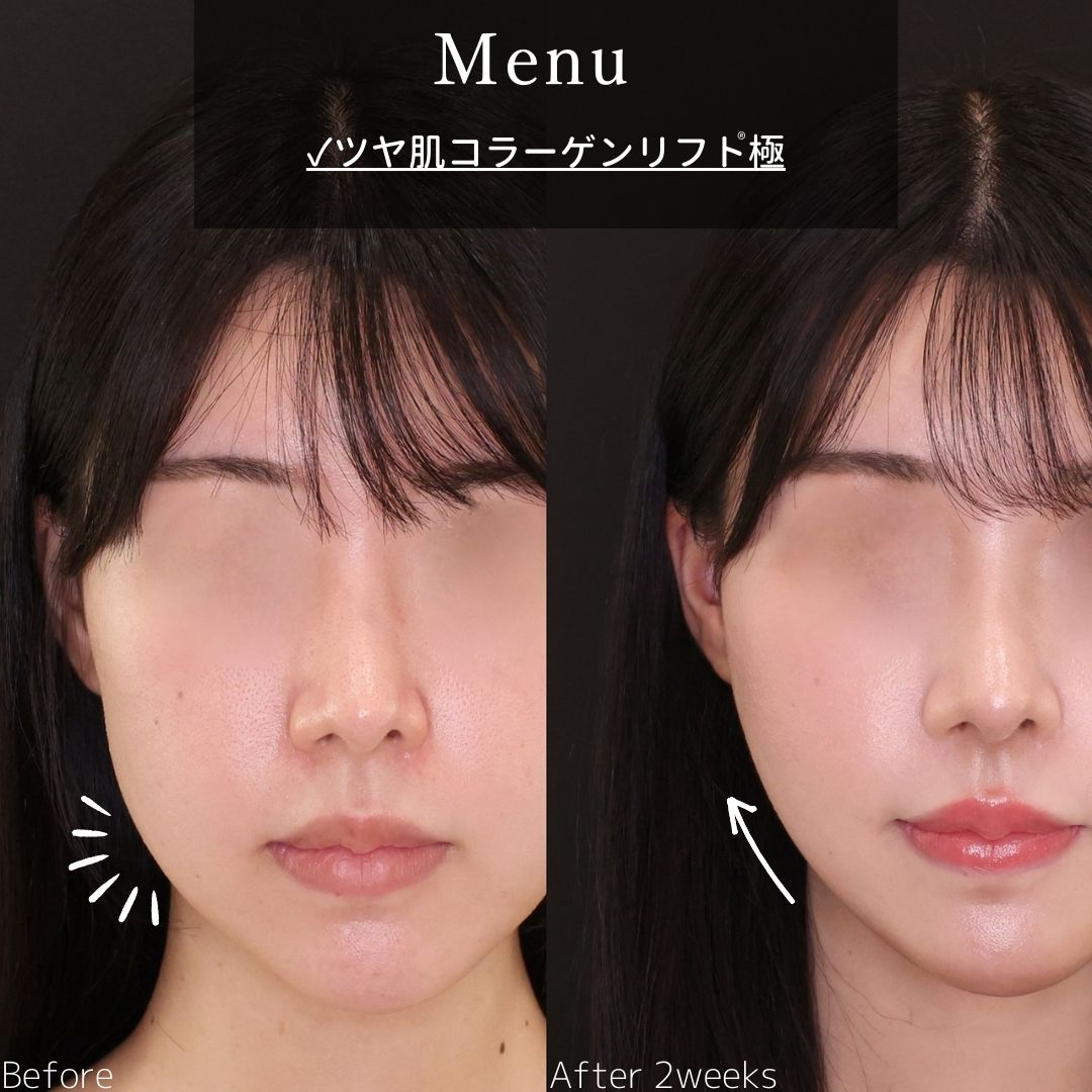 TAC式 ツヤ肌コラーゲンリフト®の症例写真 施術前後 