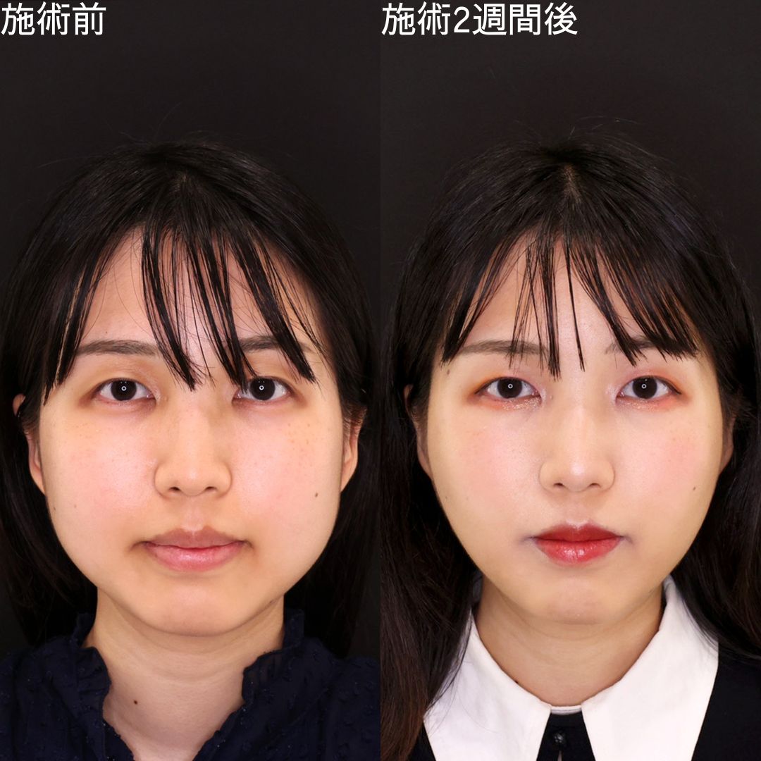 プチ整形のみでしっかりと変化を出すDr.石橋の小顔術【糸リフト】