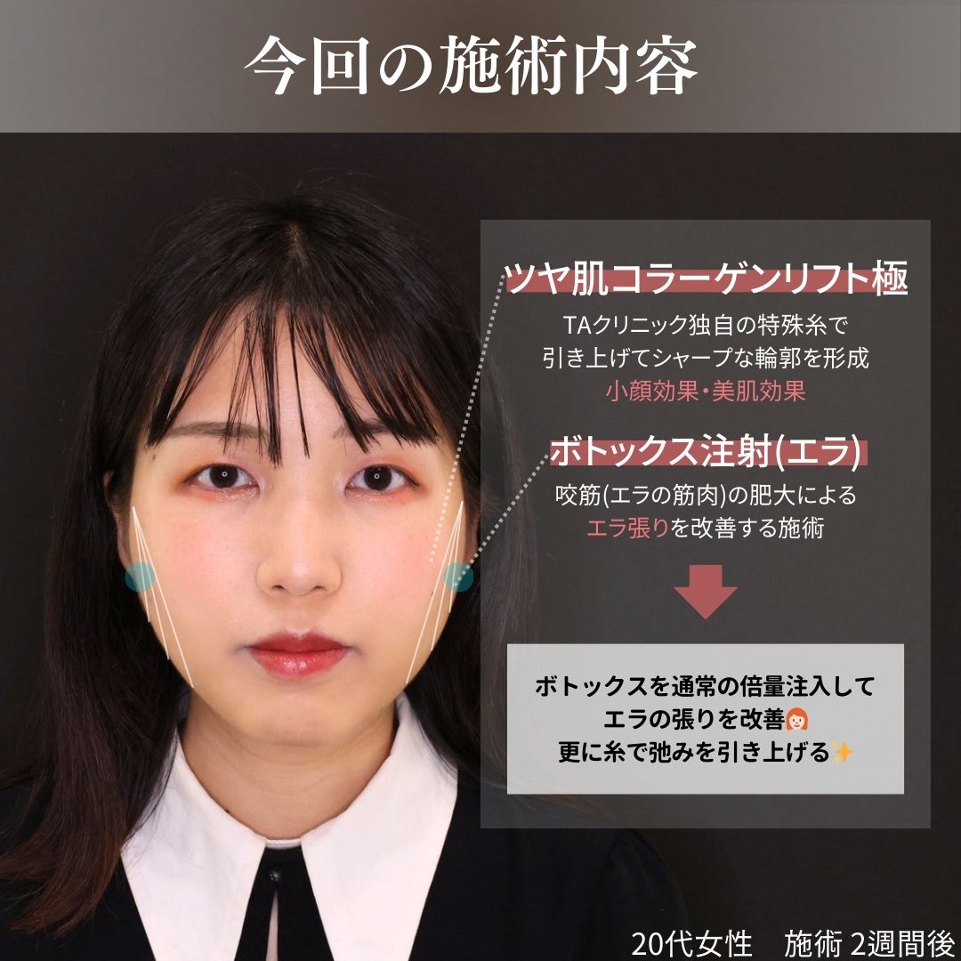 TAC式 ツヤ肌コラーゲンリフト®/エラボトックス注射の症例写真 施術前後 