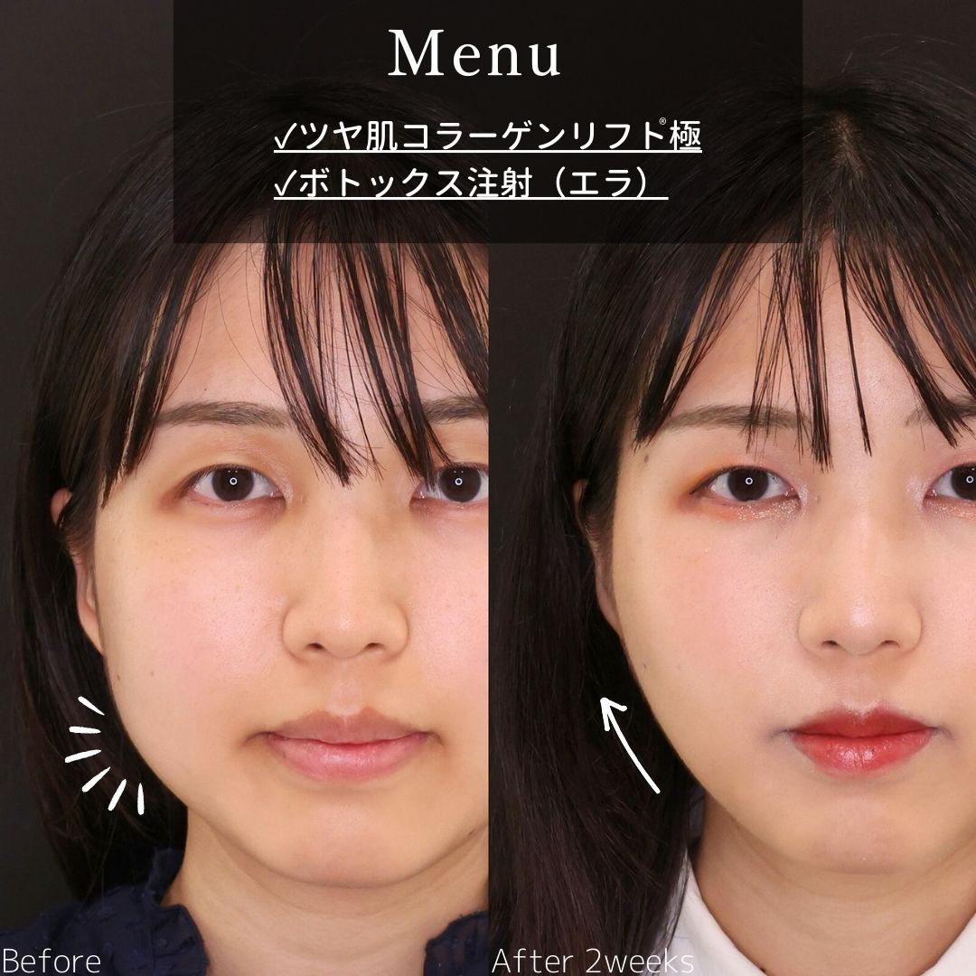 TAC式 ツヤ肌コラーゲンリフト®/エラボトックス注射の症例写真 施術前後 