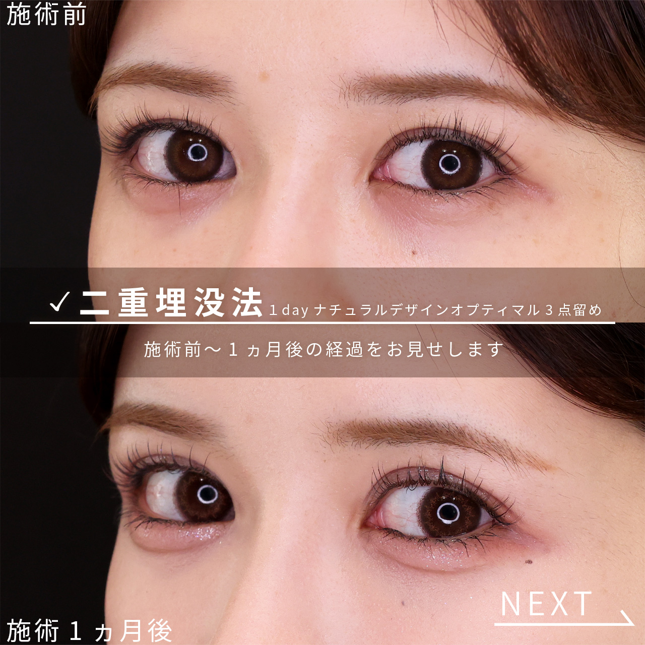 二重埋没法の症例写真 施術前後 