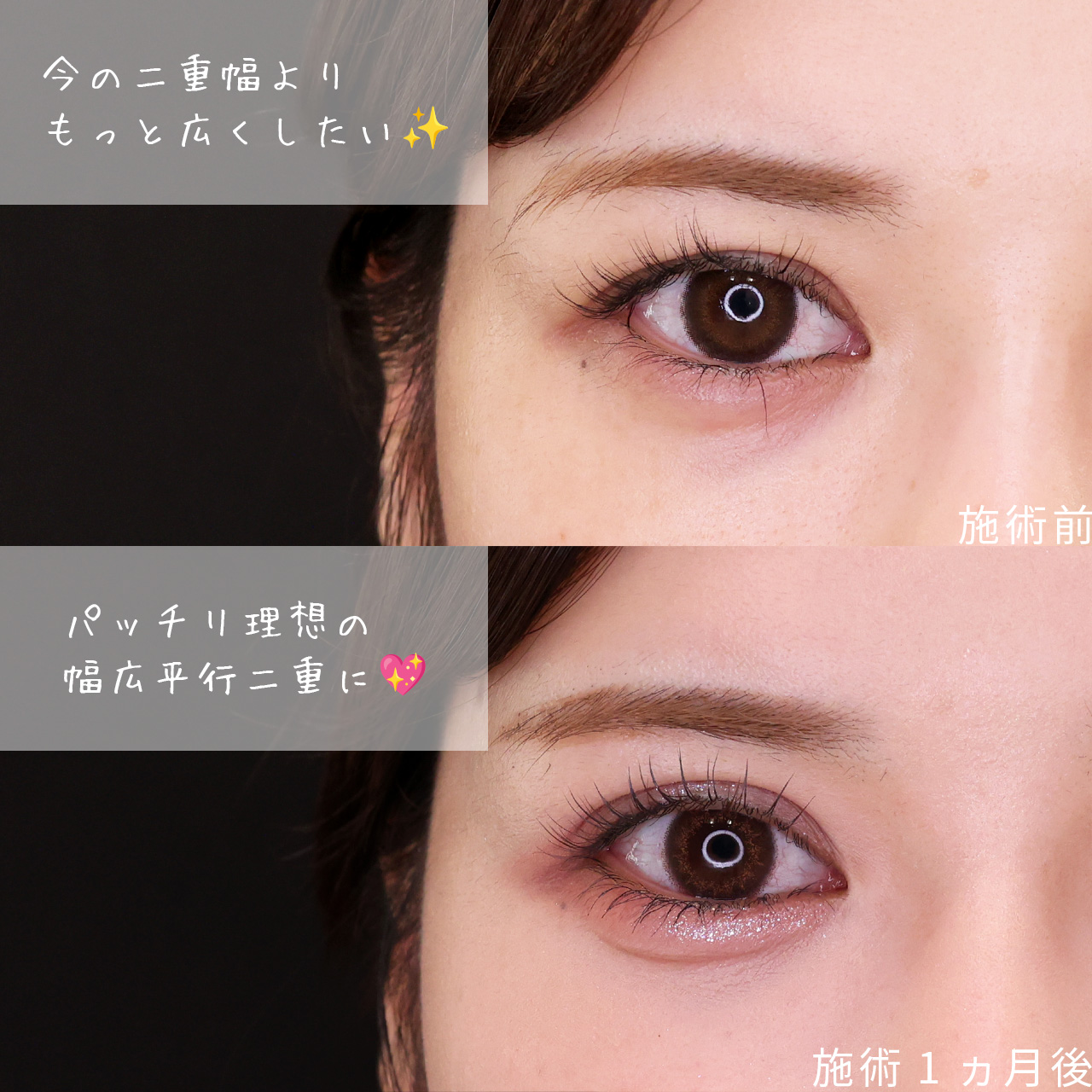 二重埋没法の症例写真 施術前後 