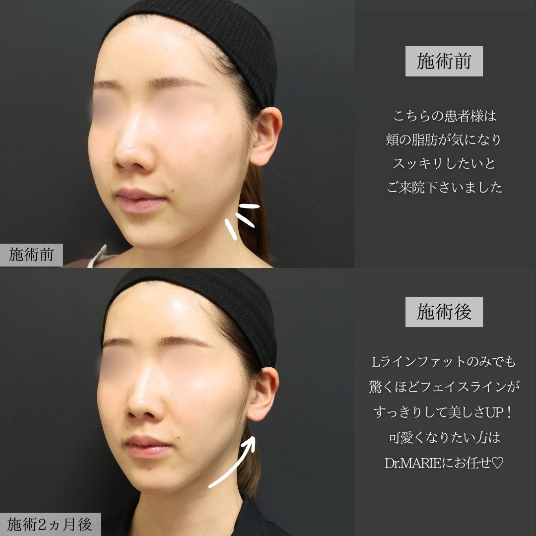 Lラインファット除去（エラ下脂肪除去）の症例写真 施術前後 