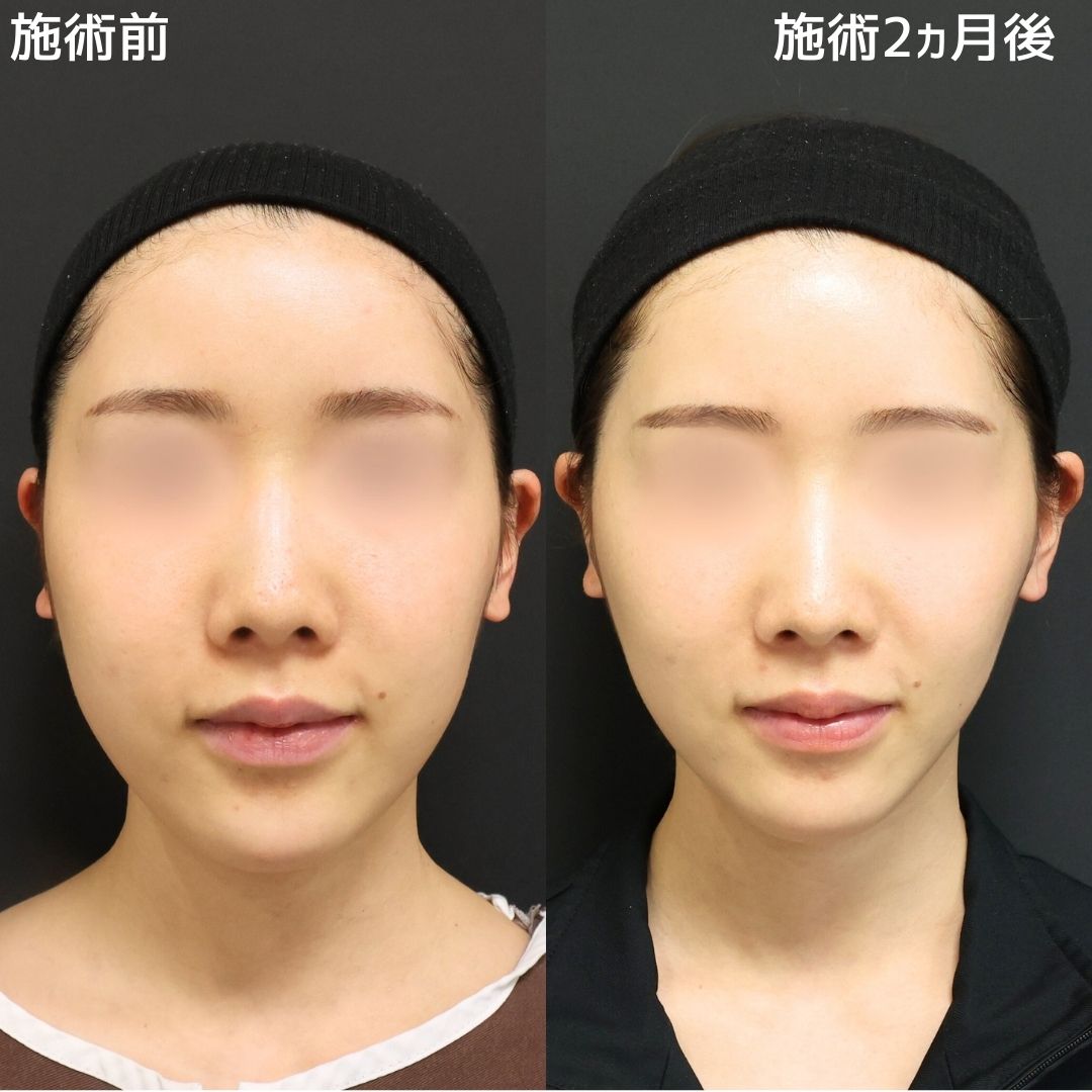 《小顔整形》Lラインファットのみでこの変化凄いです！！