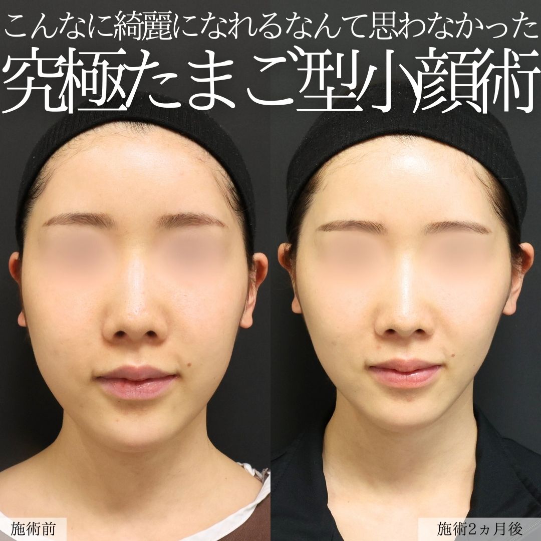 Lラインファット除去（エラ下脂肪除去）の症例写真 施術前後 