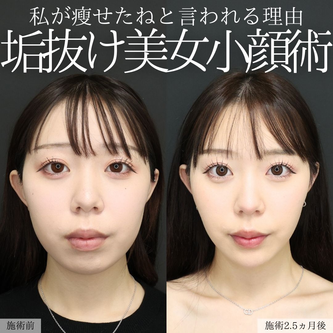 顎下の脂肪吸引/ジョールファット除去/バッカルファット除去の症例写真 施術前後 