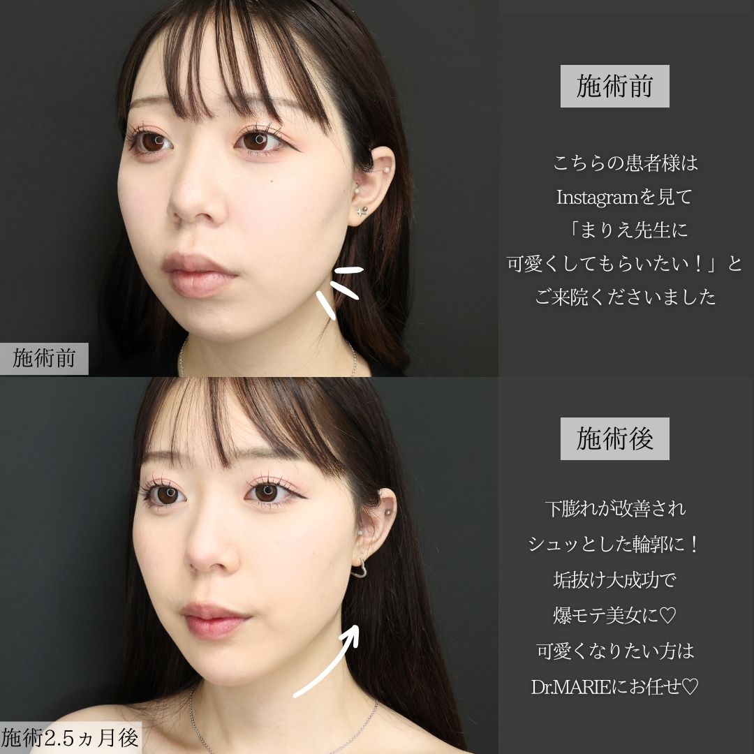 顎下の脂肪吸引/ジョールファット除去/バッカルファット除去の症例写真 施術前後 