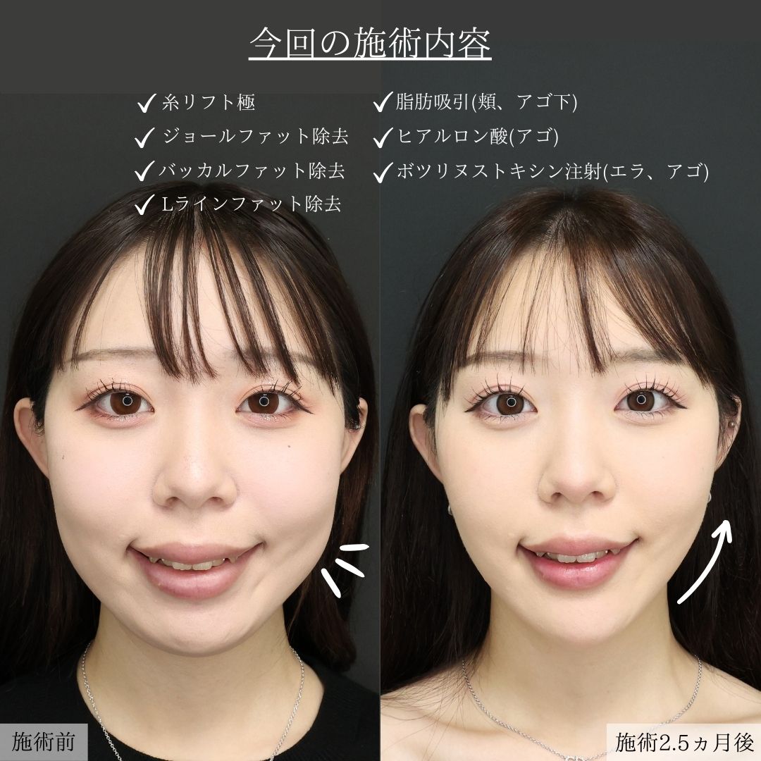 顎下の脂肪吸引/ジョールファット除去/バッカルファット除去の症例写真 施術前後 