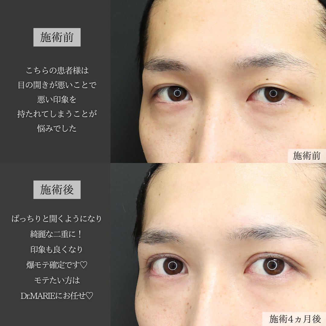 上眼瞼切開術/眼瞼下垂（目つき矯正）の症例写真 施術前後 
