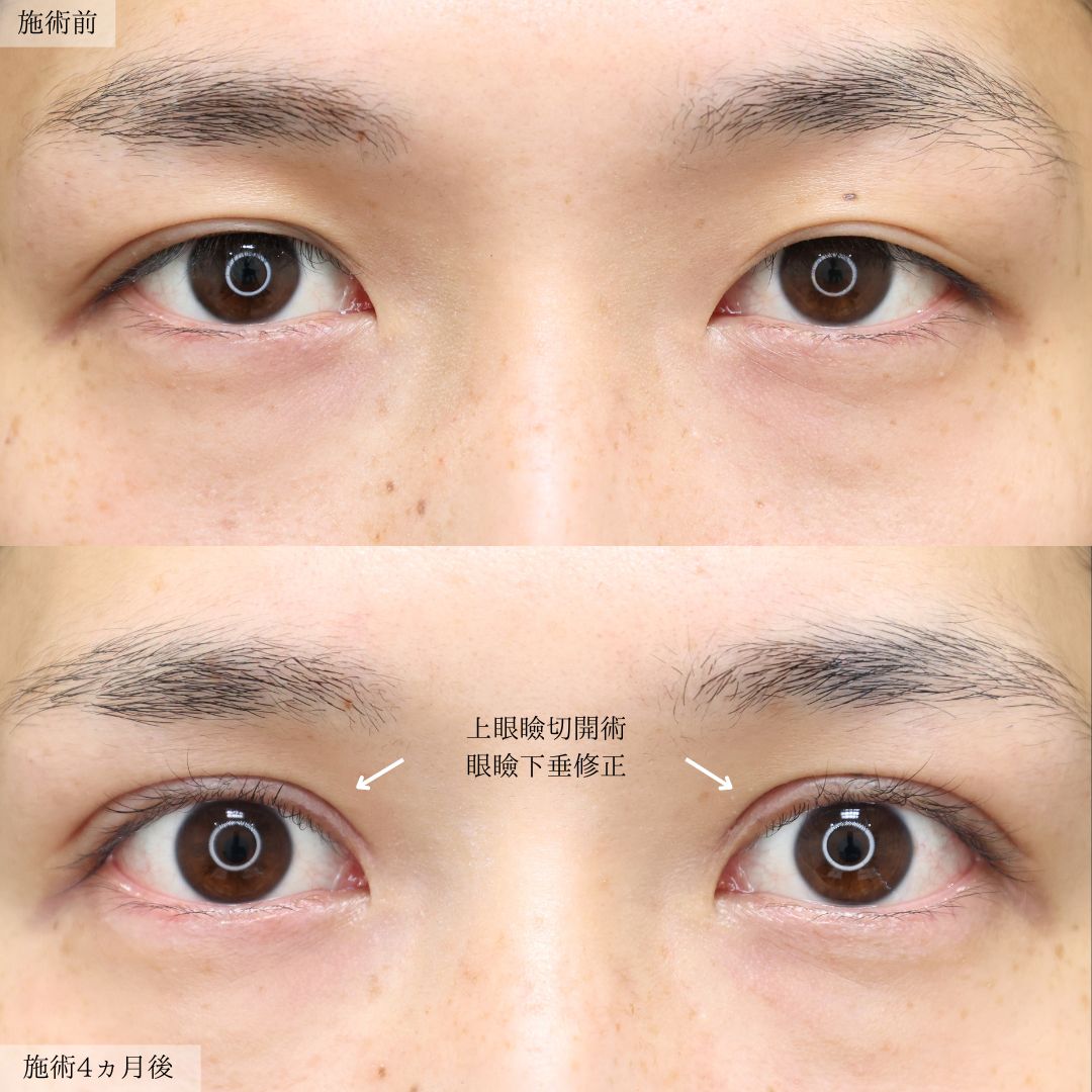 上眼瞼切開術/眼瞼下垂（目つき矯正）の症例写真 施術前後 