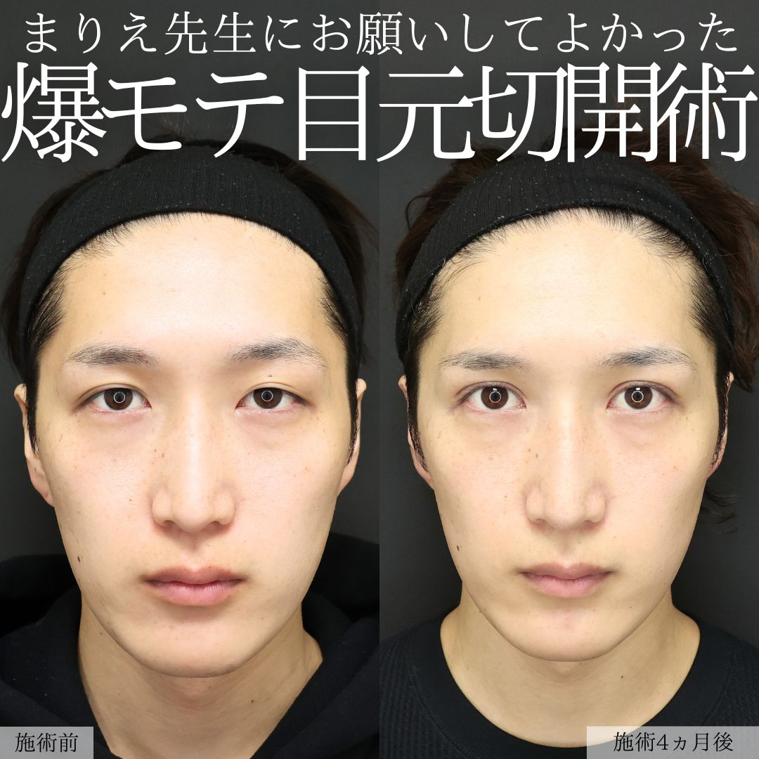 上眼瞼切開術/眼瞼下垂（目つき矯正）の症例写真 施術前後 