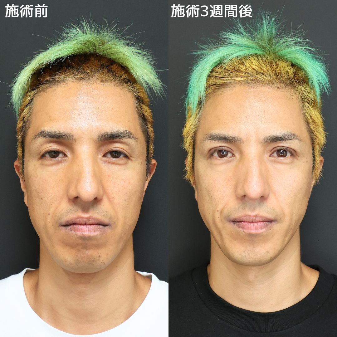 ツネ様整形《整形前画像も公開》二重整形でもうロバとは言わせない！