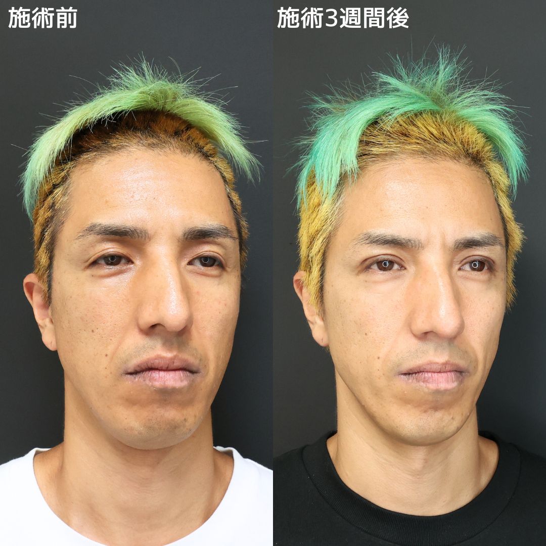 二重切開（全切開法）/上眼瞼切開術の症例写真 施術前後 