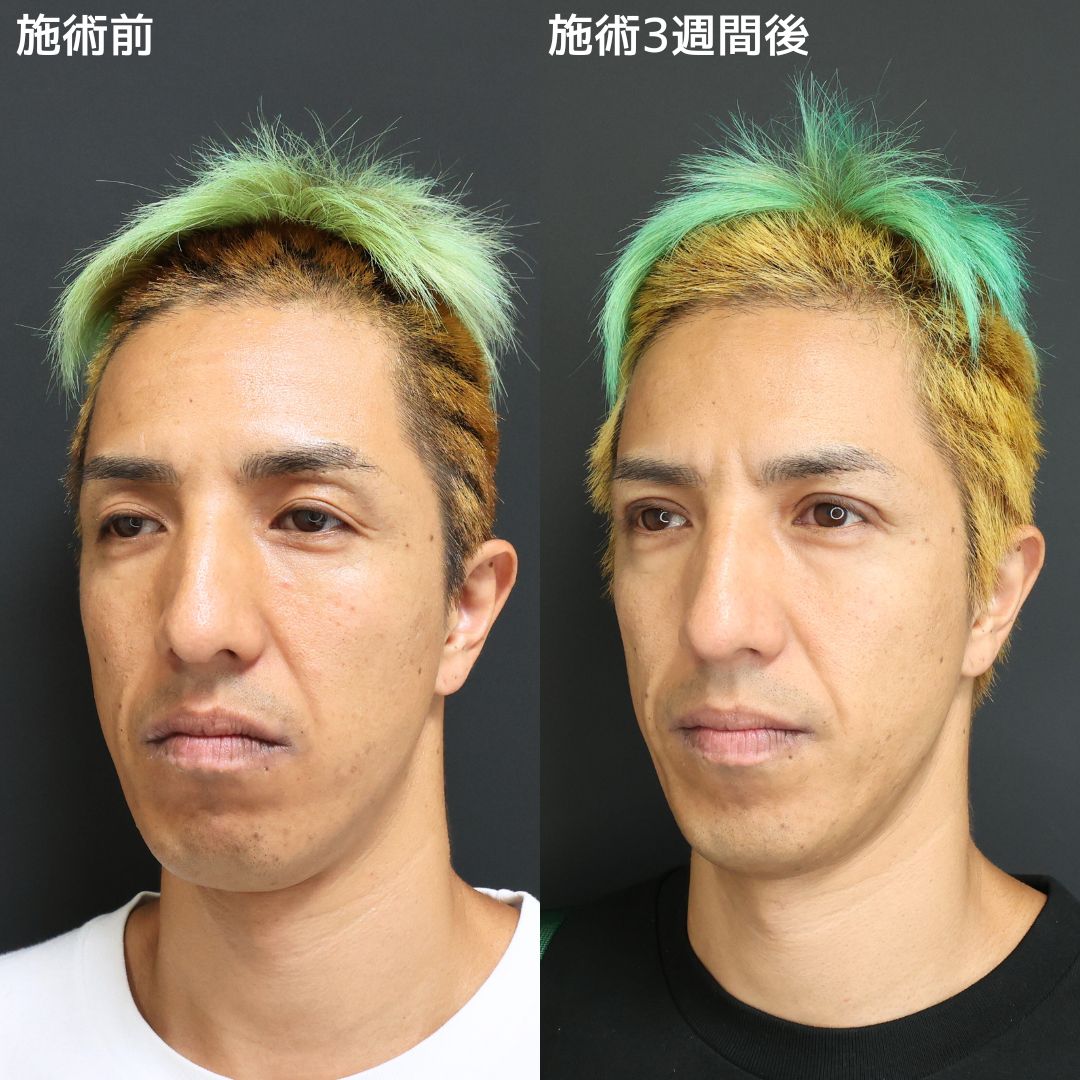 二重切開（全切開法）/上眼瞼切開術の症例写真 施術前後 