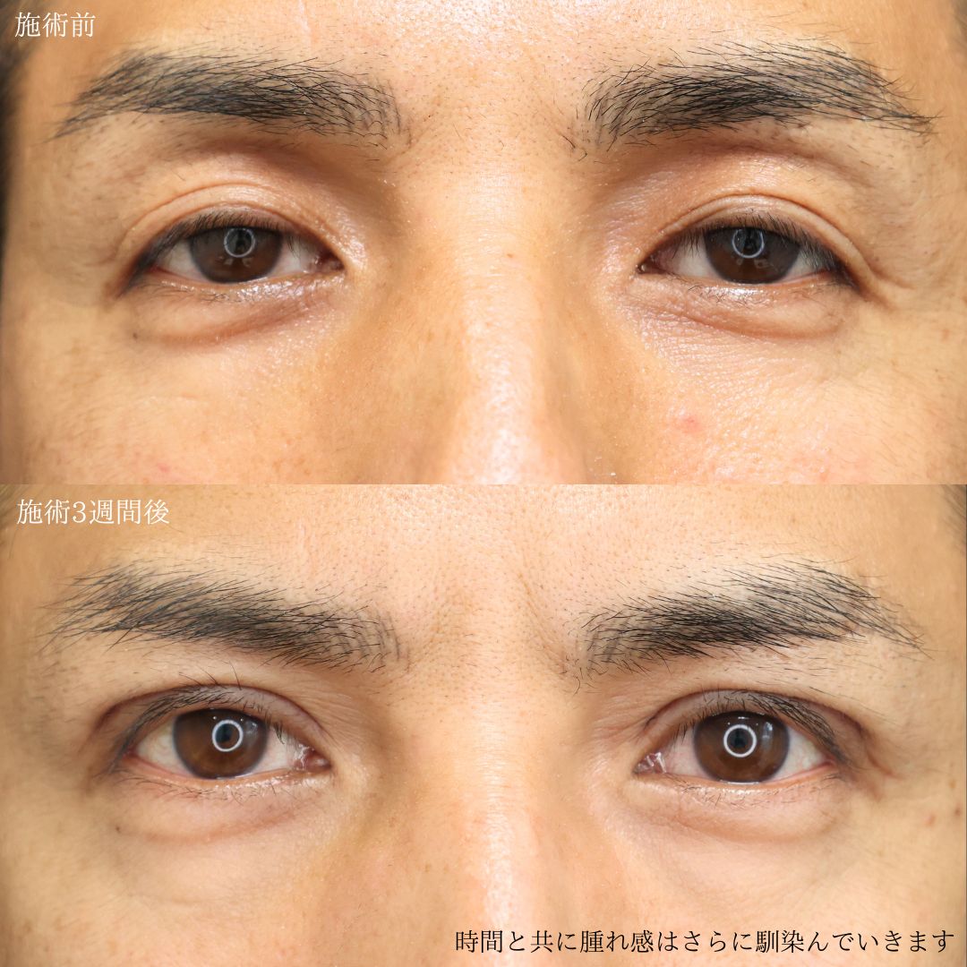 二重切開（全切開法）/上眼瞼切開術の症例写真 施術前後 