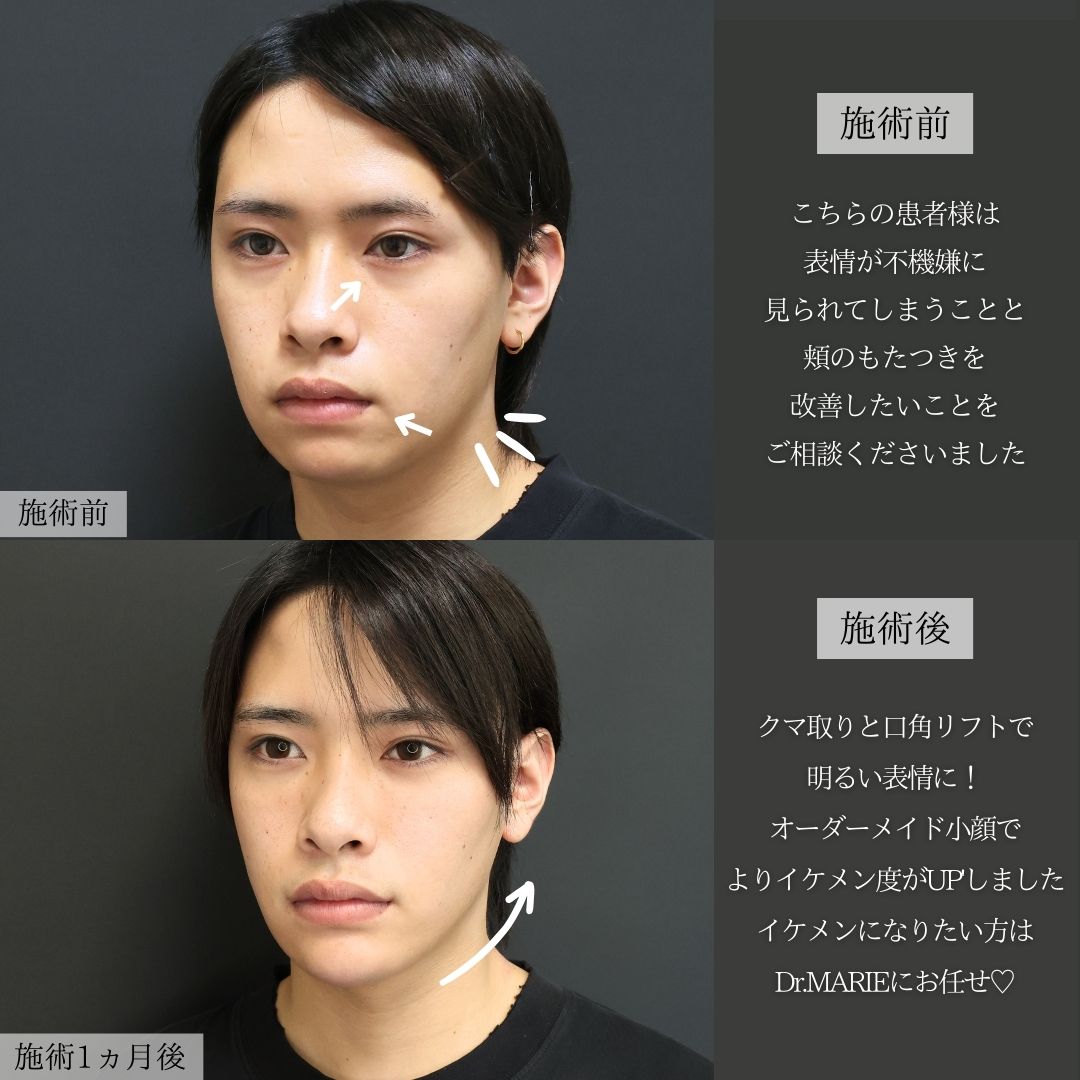 バッカルファット除去/エラボトックス注射/顔の脂肪吸引の症例写真 施術前後