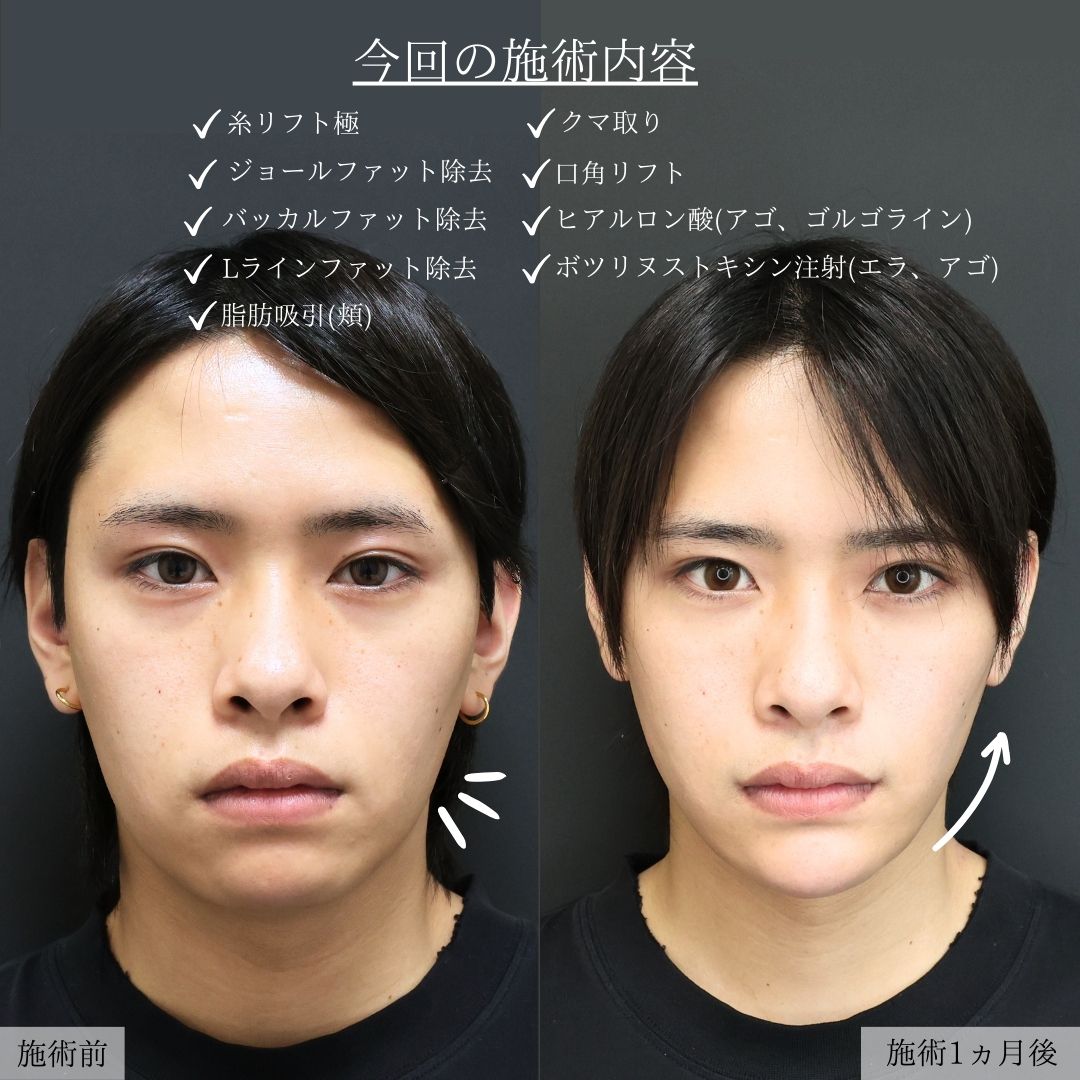 バッカルファット除去/エラボトックス注射/顔の脂肪吸引の症例写真 施術前後