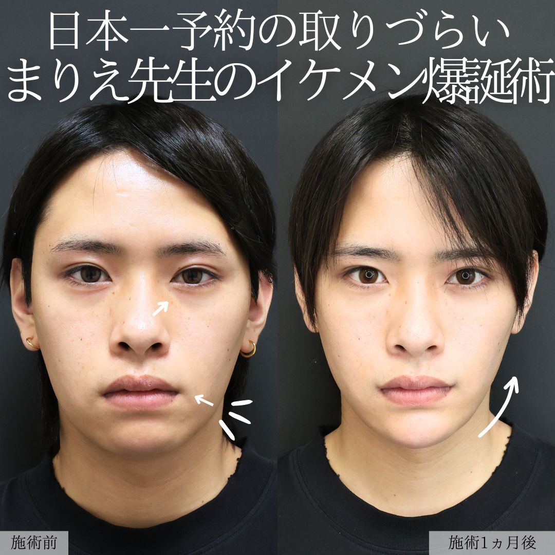 バッカルファット除去/エラボトックス注射/顔の脂肪吸引の症例写真 施術前後 