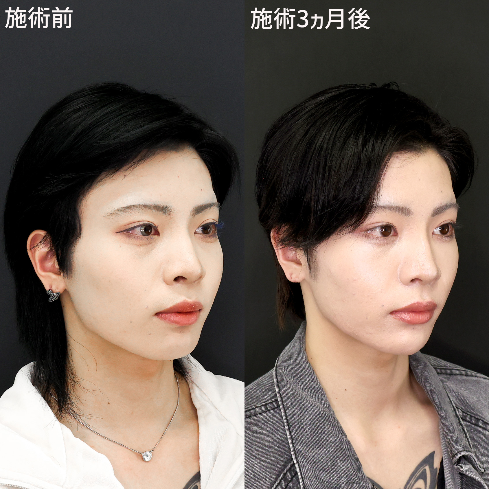 TAC式 ツヤ肌コラーゲンリフト®/おでこ・こめかみのヒアルロン酸注射/目の下のヒアルロン酸注射の症例写真 施術前後 