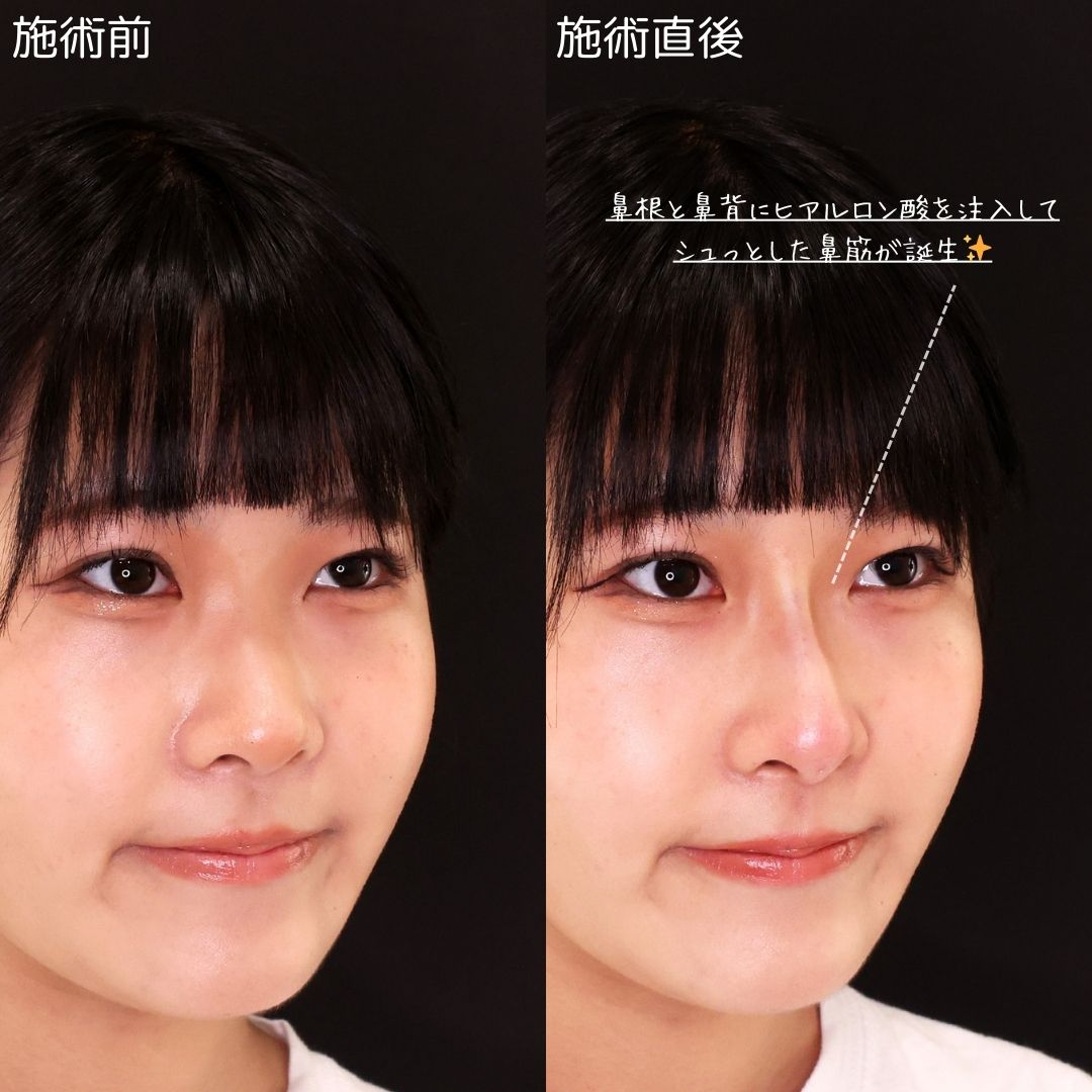 鼻のヒアルロン酸注射の症例写真 施術前後