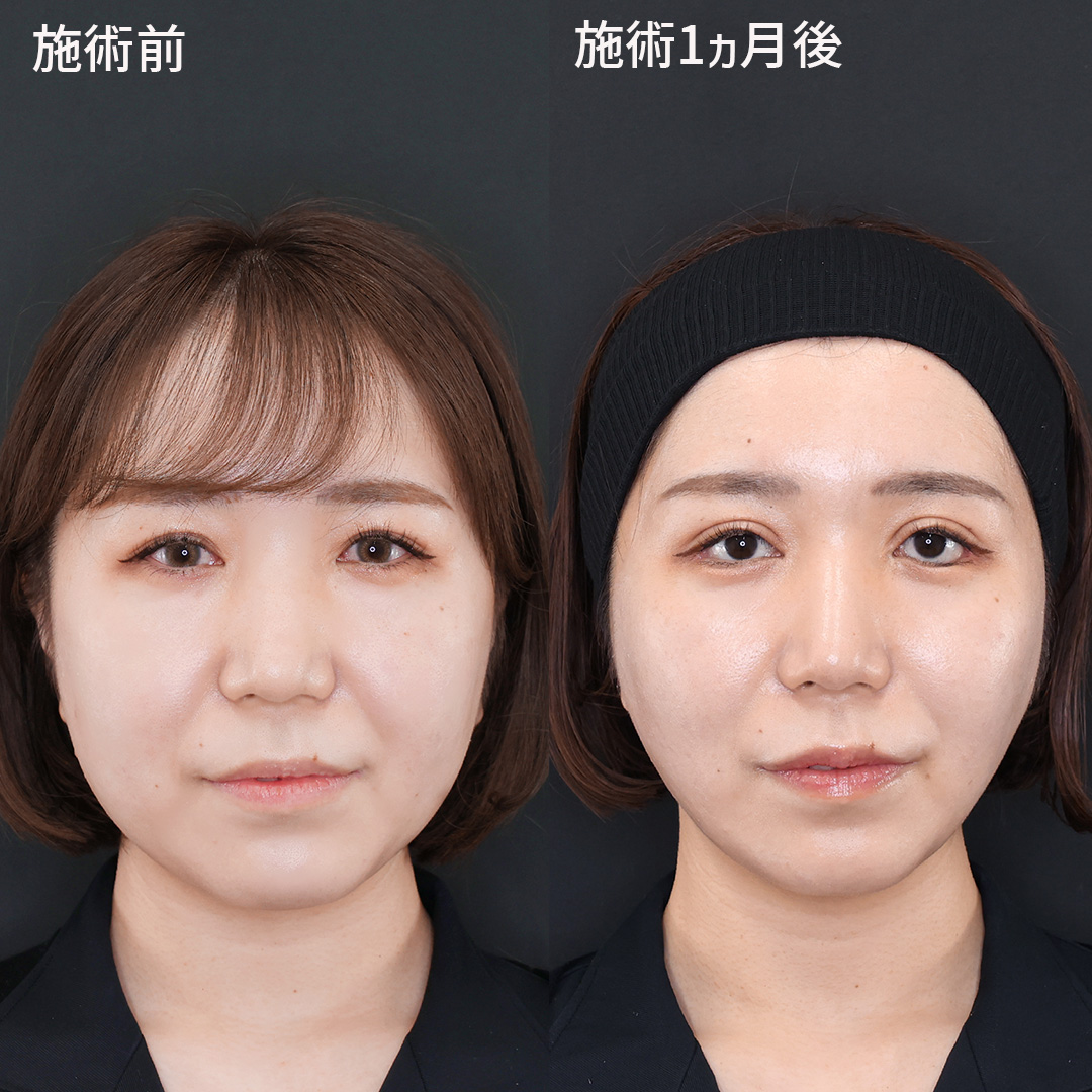 【ナゾラビアルファット除去】ほうれい線上の脂肪を除去して垢抜け