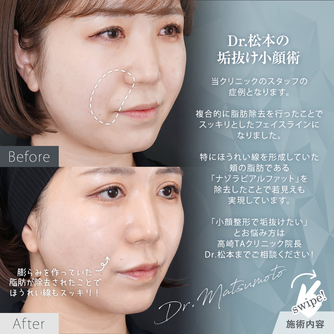 TAC式 ツヤ肌コラーゲンリフト®/ナゾラビアルファット除去/バッカルファット除去の症例写真 施術前後 