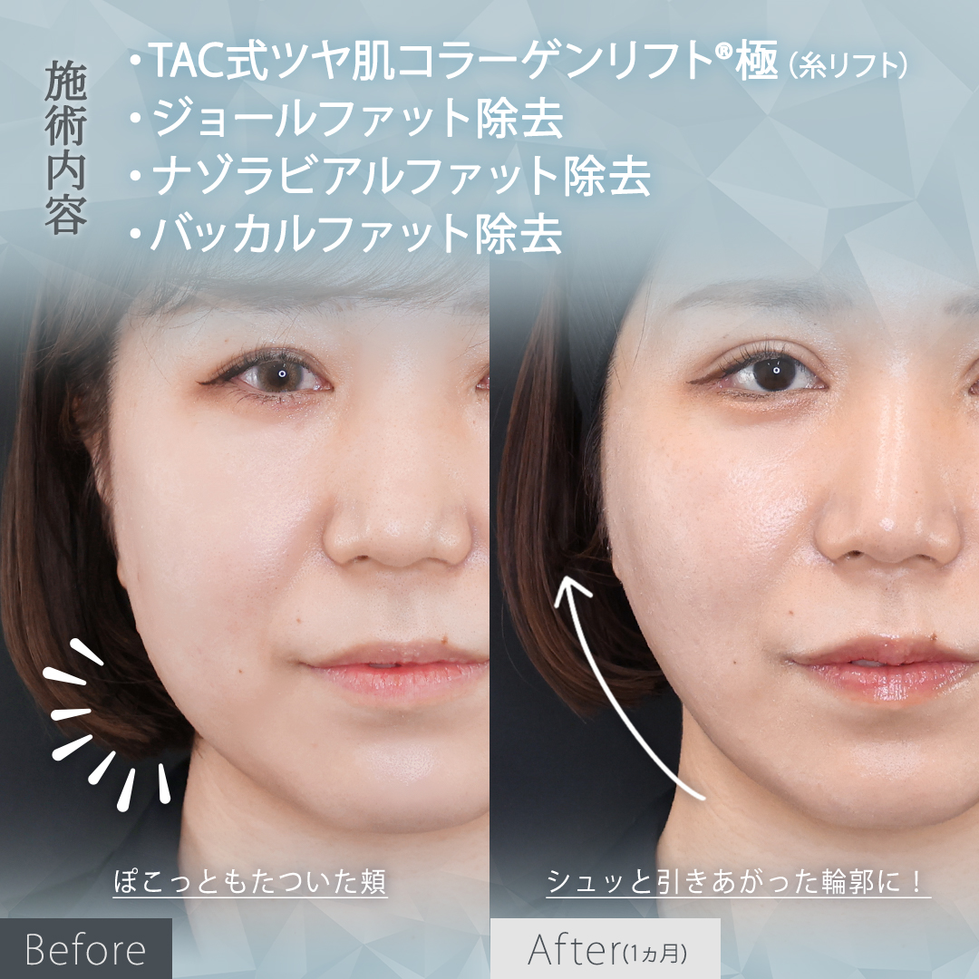 TAC式 ツヤ肌コラーゲンリフト®/ナゾラビアルファット除去/バッカルファット除去の症例写真 施術前後 