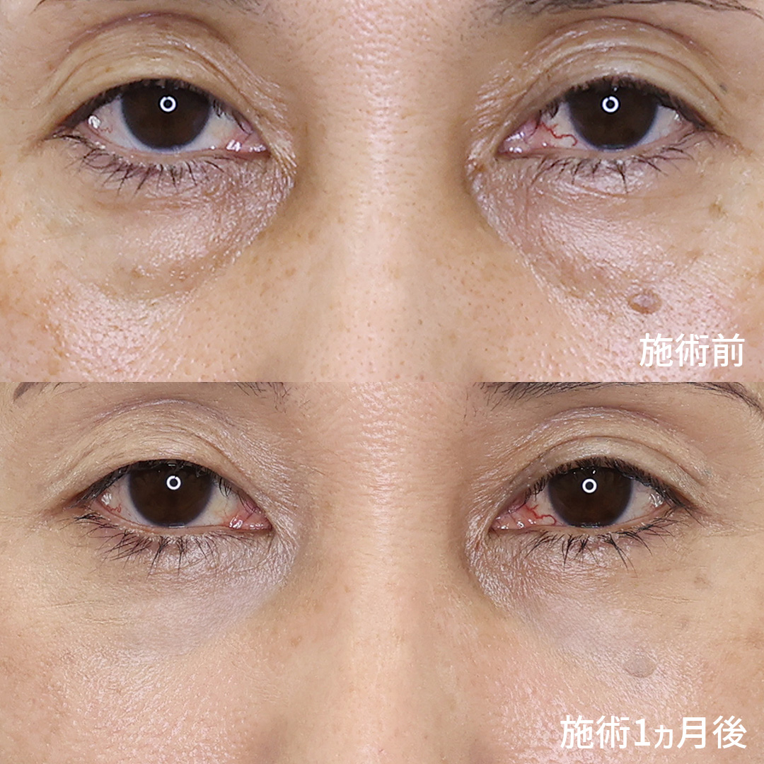 【若さ取り戻す目元整形】目の下のクマ取り
