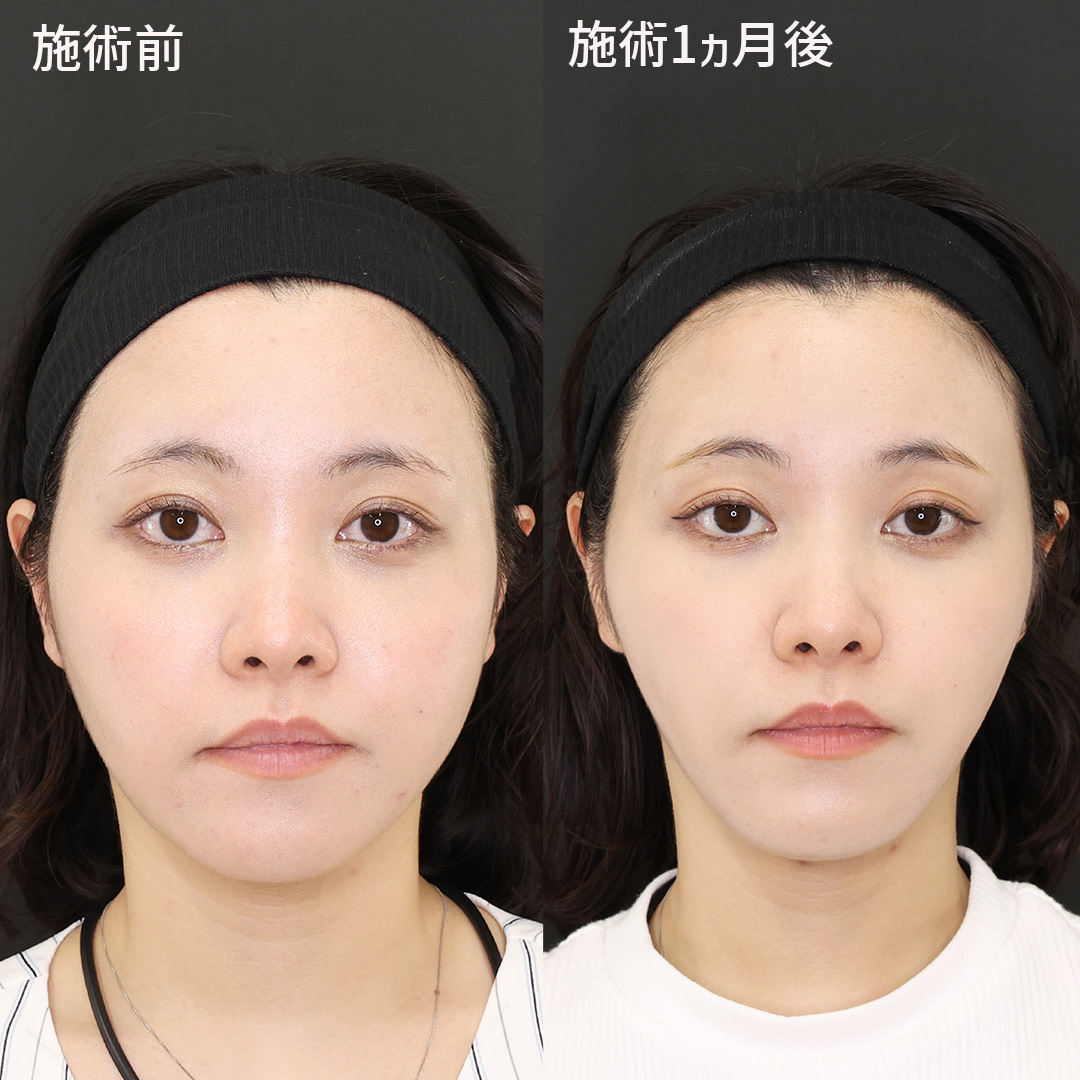 【究極の小顔術】口元の弛みを改善して垢抜け