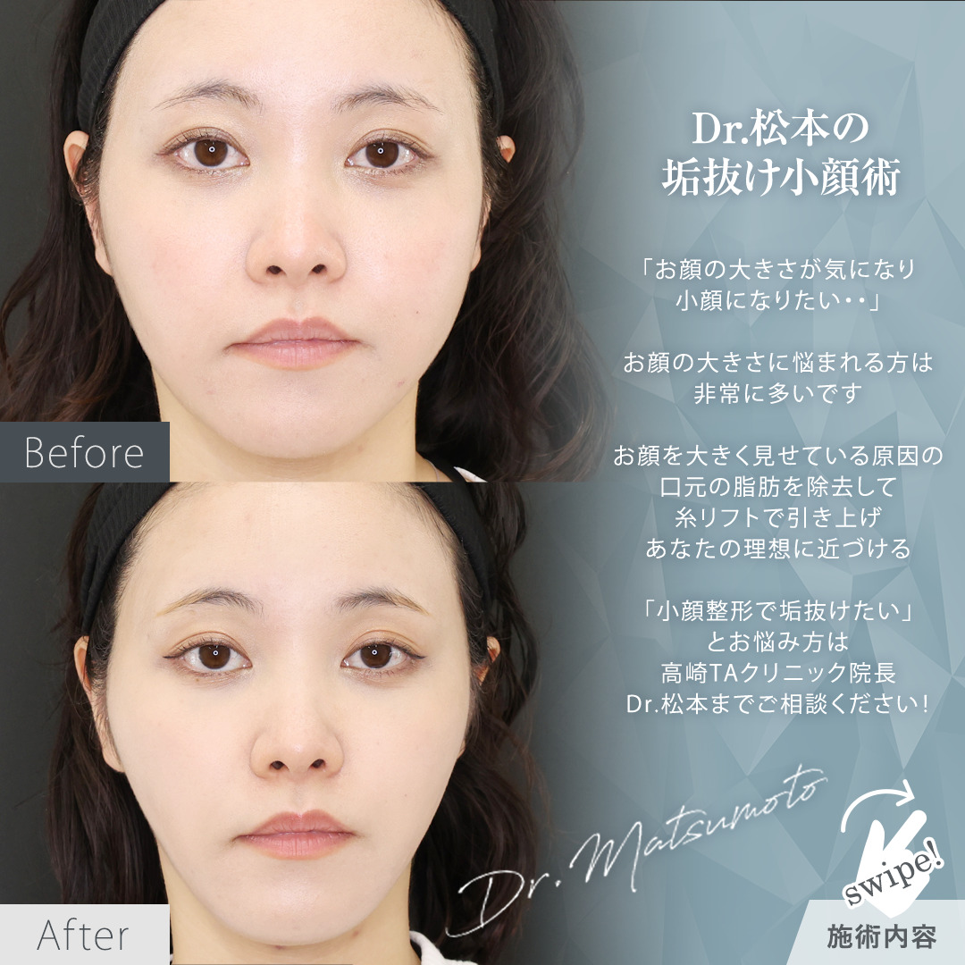 TAC式 ツヤ肌コラーゲンリフト®/ジョールファット除去/エラボトックス注射の症例写真 施術前後 