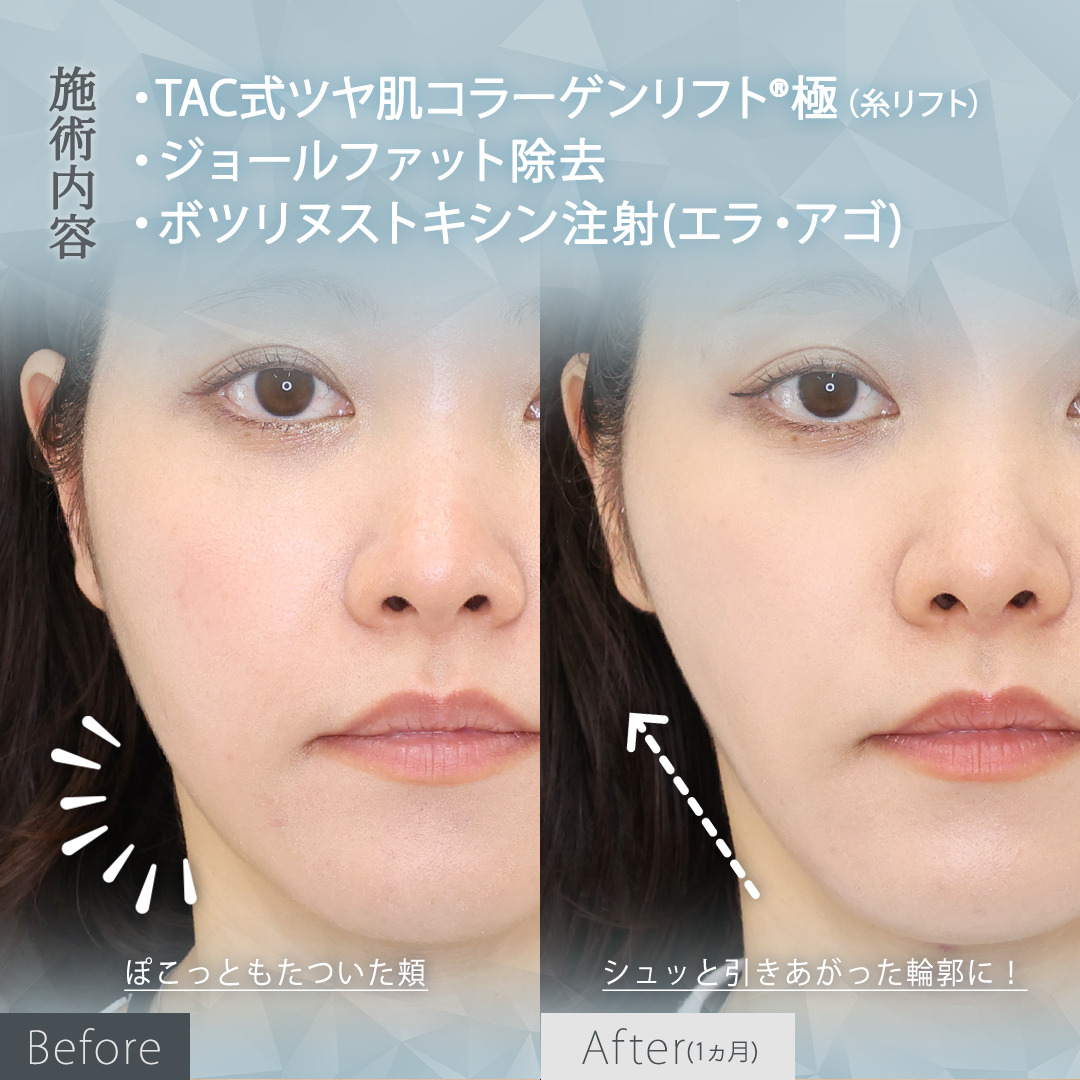 TAC式 ツヤ肌コラーゲンリフト®/ジョールファット除去/エラボトックス注射の症例写真 施術前後 