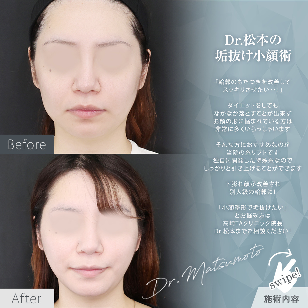 TAC式 ツヤ肌コラーゲンリフト®/エラボトックス注射の症例写真 施術前後 