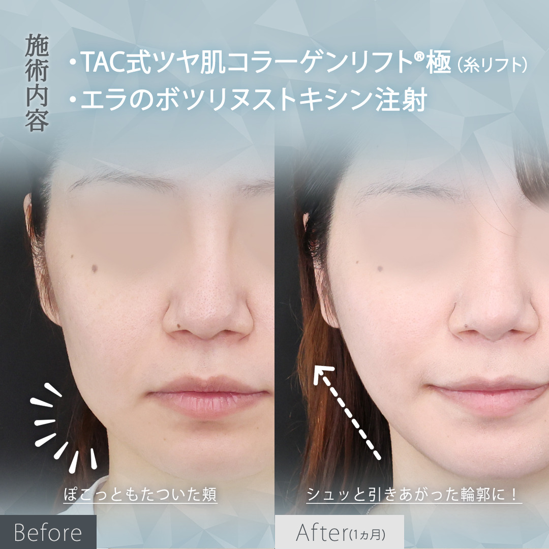 TAC式 ツヤ肌コラーゲンリフト®/エラボトックス注射の症例写真 施術前後 