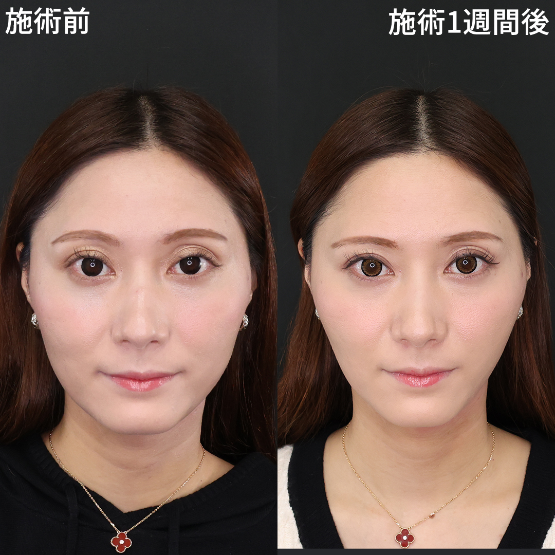 糸リフトでフェイスライン激変！ほうれい線も解消でさらに小顔美人に✨