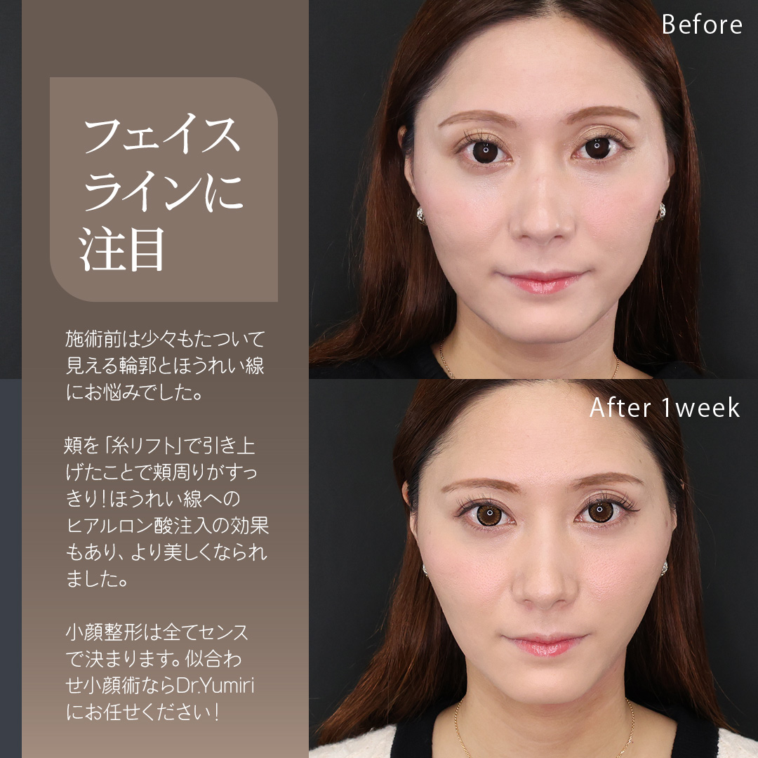 TAC式 ツヤ肌コラーゲンリフト®/エラボトックス注射/ほうれい線のヒアルロン酸注射の症例写真 施術前後 