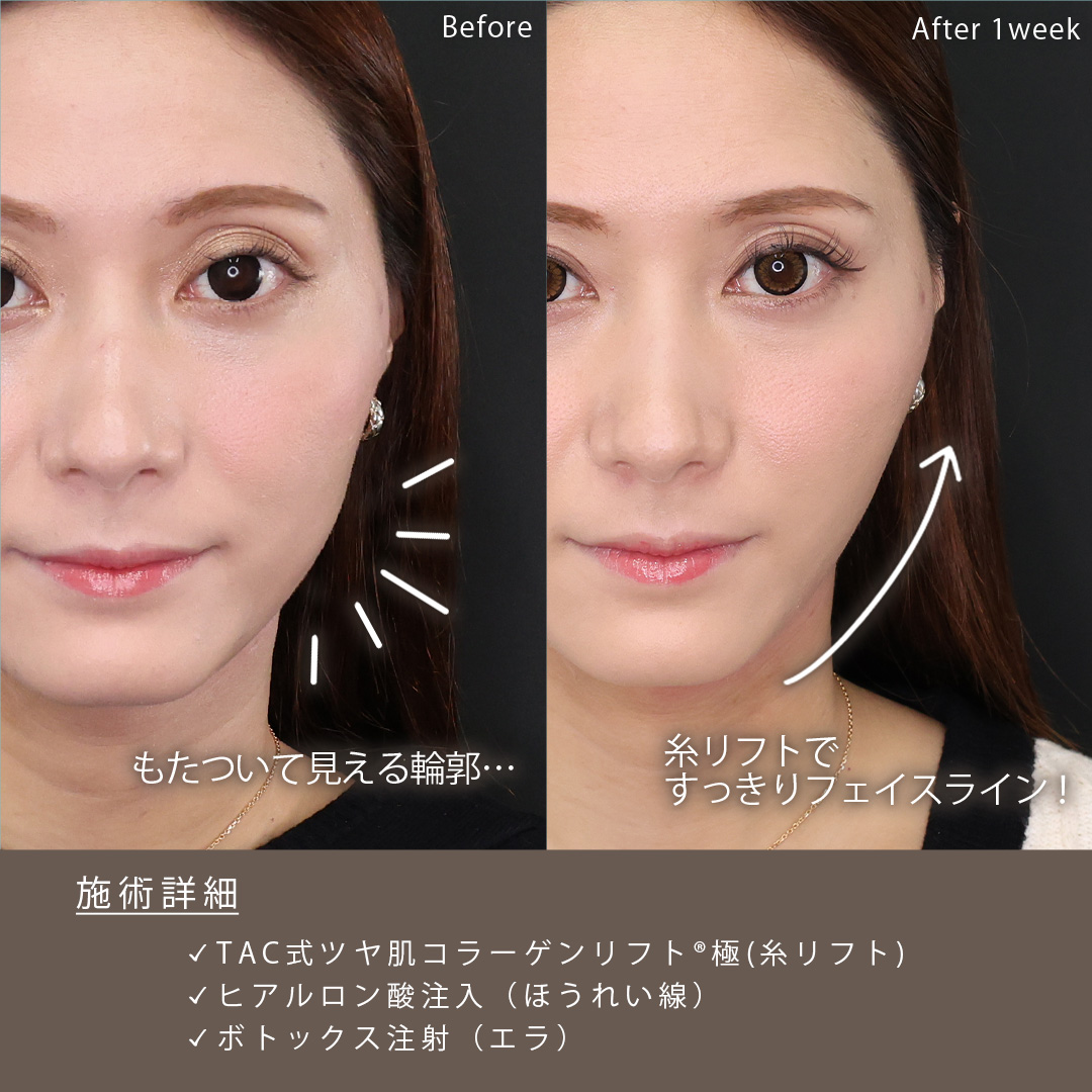 TAC式 ツヤ肌コラーゲンリフト®/エラボトックス注射/ほうれい線のヒアルロン酸注射の症例写真 施術前後 